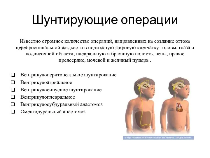 Шунтирующие операции Известно огромное количество операций, направленных на создание оттока цереброспинальной