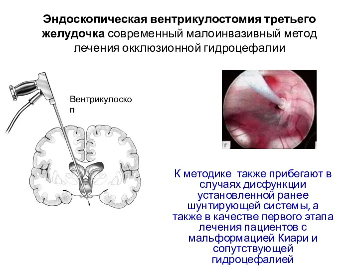 Эндоскопическая вентрикулостомия третьего желудочка современный малоинвазивный метод лечения окклюзионной гидроцефалии К