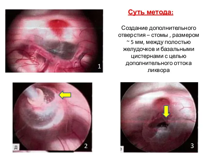 Суть метода: Создание дополнительного отверстия – стомы , размером ~ 5