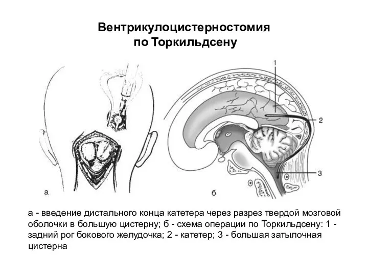 Вентрикулоцистерностомия по Торкильдсену а - введение дистального конца катетера через разрез