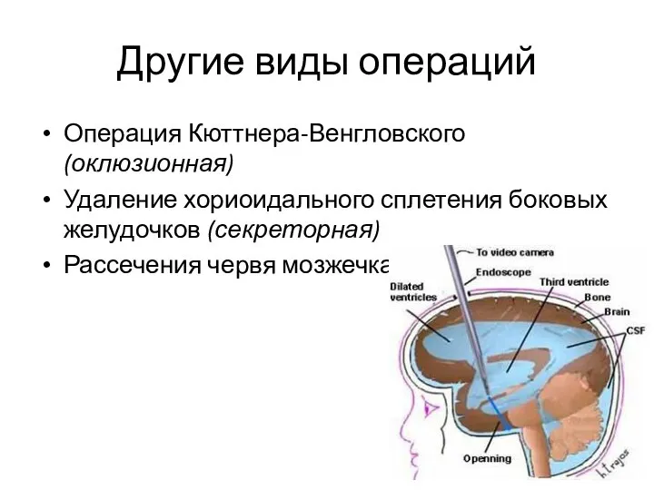 Другие виды операций Операция Кюттнера-Венгловского (оклюзионная) Удаление хориоидального сплетения боковых желудочков (секреторная) Рассечения червя мозжечка