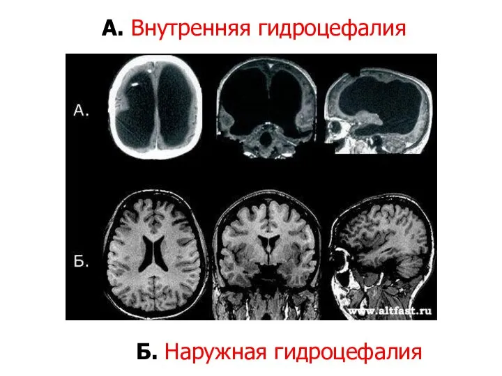 А. Внутренняя гидроцефалия Б. Наружная гидроцефалия