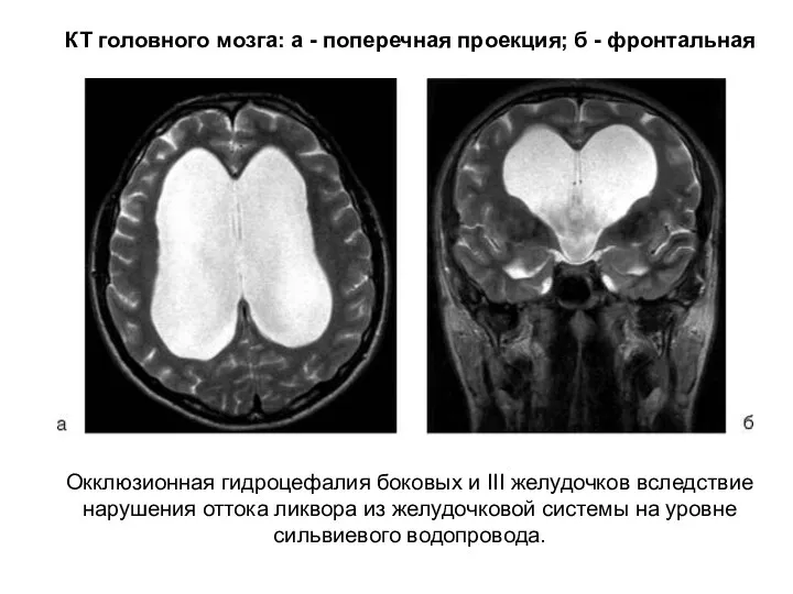 Окклюзионная гидроцефалия боковых и III желудочков вследствие нарушения оттока ликвора из