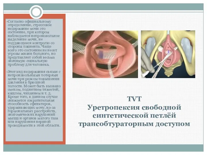 TVT Уретропексия свободной синтетической петлёй трансобтураторным доступом Согласно официальному определению, стрессовое