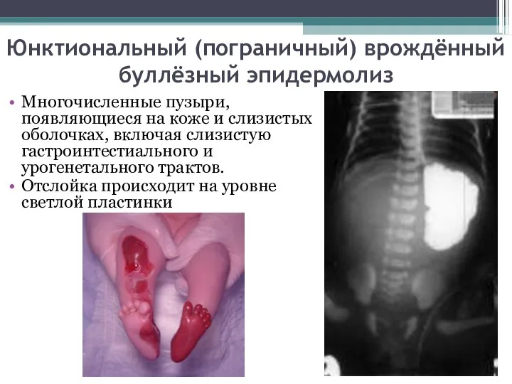 Юнктиональный (пограничный) врождённый буллёзный эпидермолиз Многочисленные пузыри, появляющиеся на коже и