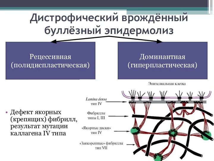 Дистрофический врождённый буллёзный эпидермолиз Дефект якорных (крепящих) фибрилл, результат мутации каллагена