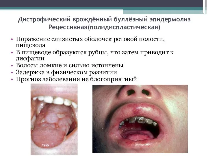 Дистрофический врождённый буллёзный эпидермолиз Рецессивная(полидиспластическая) Поражение слизистых оболочек ротовой полости, пищевода