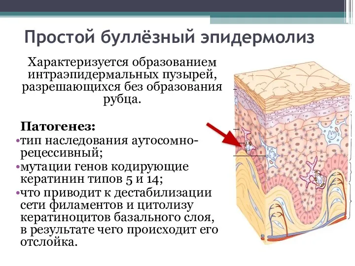 Простой буллёзный эпидермолиз Характеризуется образованием интраэпидермальных пузырей, разрешающихся без образования рубца.