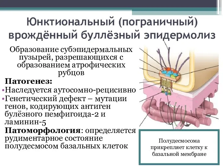 Юнктиональный (пограничный) врождённый буллёзный эпидермолиз Образование субэпидермальных пузырей, разрешающихся с образованием