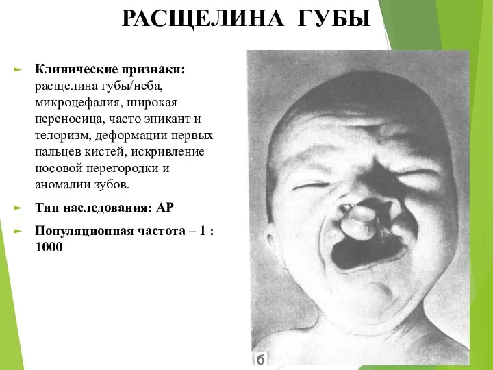 РАСЩЕЛИНА ГУБЫ Клинические признаки: расщелина губы/неба, микроцефалия, широкая переносица, часто эпикант