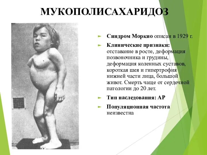 МУКОПОЛИСАХАРИДОЗ Синдром Моркио описан в 1929 г. Клинические признаки: отставание в