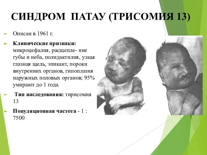 СИНДРОМ ПАТАУ (ТРИСОМИЯ 13) Описан в 1961 г. Клинические признаки: микроцефалия,