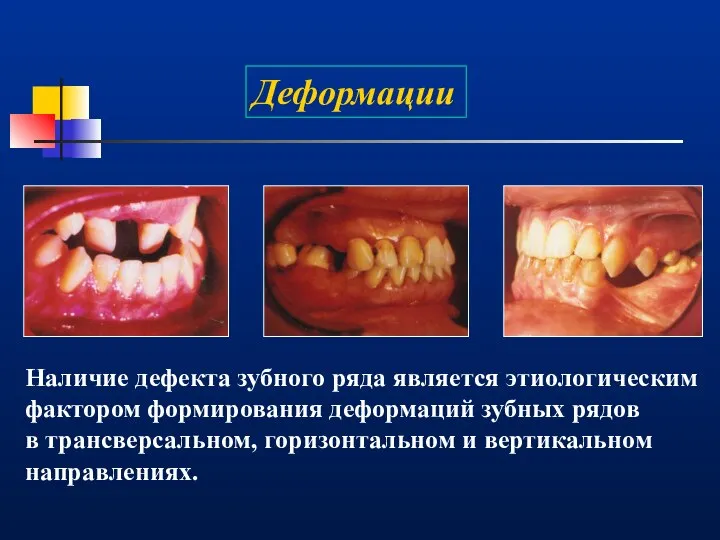 Деформации Наличие дефекта зубного ряда является этиологическим фактором формирования деформаций зубных