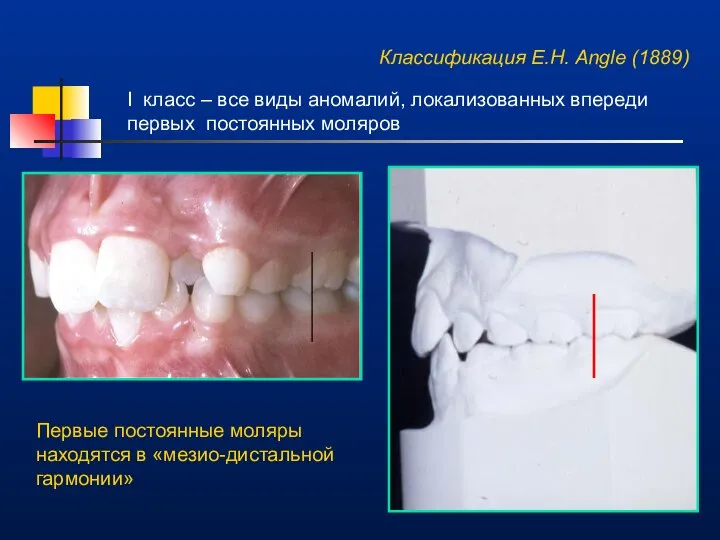 Классификация E.H. Angle (1889) I класс – все виды аномалий, локализованных