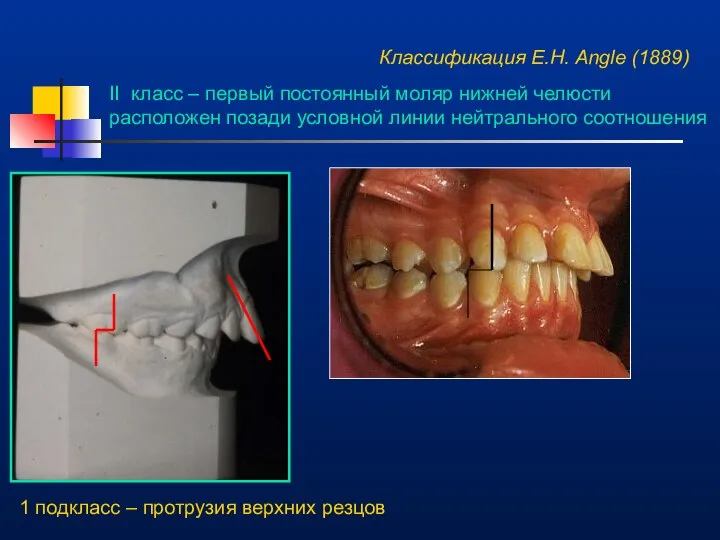 Классификация E.H. Angle (1889) II класс – первый постоянный моляр нижней