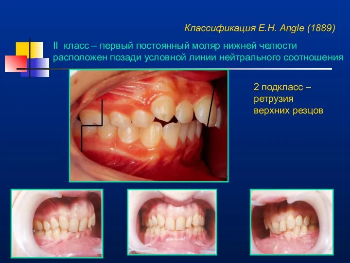 Классификация E.H. Angle (1889) II класс – первый постоянный моляр нижней