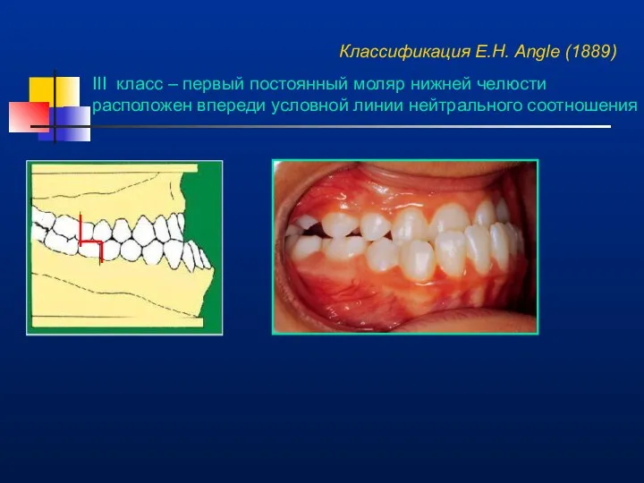 Классификация E.H. Angle (1889) III класс – первый постоянный моляр нижней