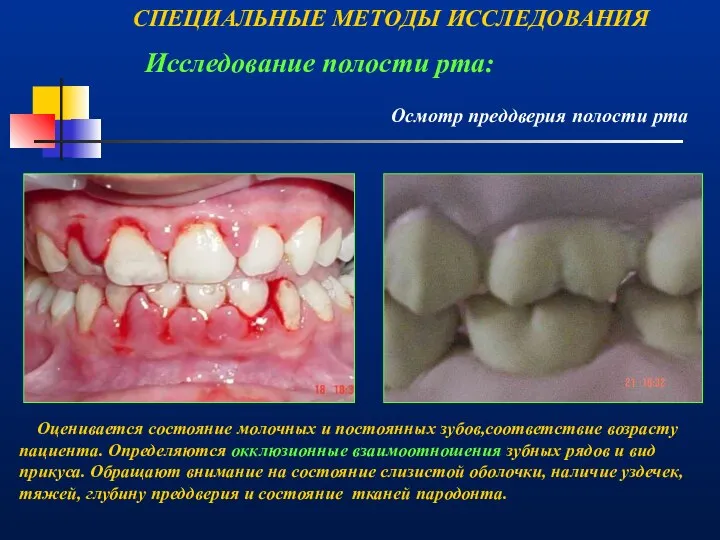 Осмотр преддверия полости рта СПЕЦИАЛЬНЫЕ МЕТОДЫ ИССЛЕДОВАНИЯ Исследование полости рта: Оценивается