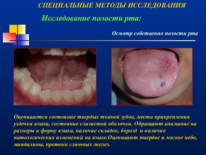 СПЕЦИАЛЬНЫЕ МЕТОДЫ ИССЛЕДОВАНИЯ Осмотр собственно полости рта Исследование полости рта: Оценивается