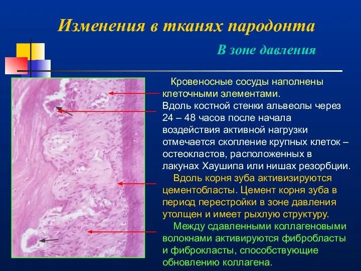 Изменения в тканях пародонта В зоне давления Кровеносные сосуды наполнены клеточными