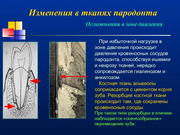 Изменения в тканях пародонта Осложнения в зоне давления При избыточной нагрузке