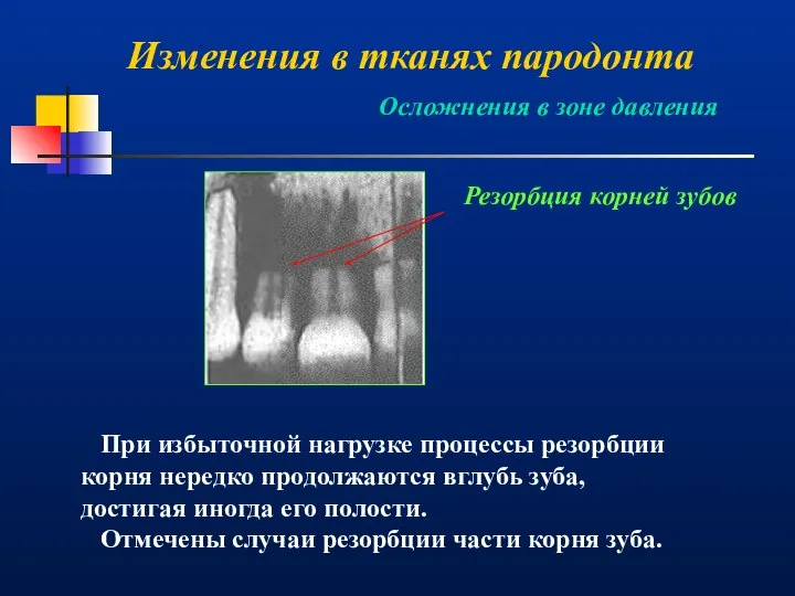 Изменения в тканях пародонта Резорбция корней зубов При избыточной нагрузке процессы