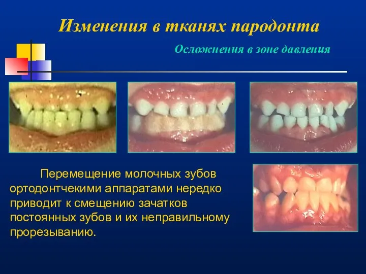 Изменения в тканях пародонта Осложнения в зоне давления Перемещение молочных зубов