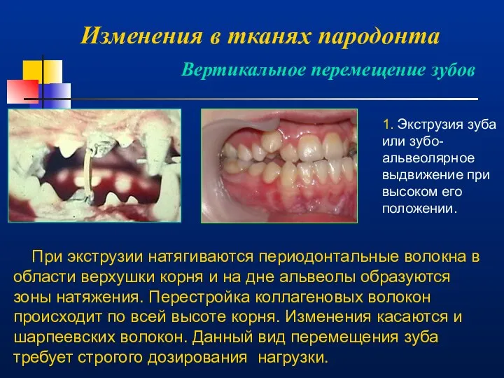 Изменения в тканях пародонта Вертикальное перемещение зубов 1. Экструзия зуба или