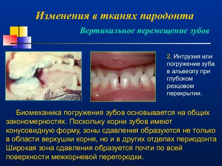 Изменения в тканях пародонта Вертикальное перемещение зубов 2. Интрузия или погружение