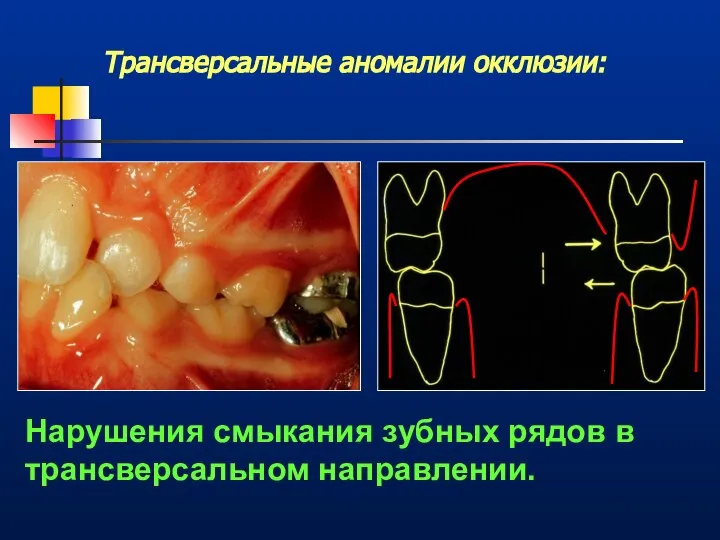Трансверсальные аномалии окклюзии: Нарушения смыкания зубных рядов в трансверсальном направлении.