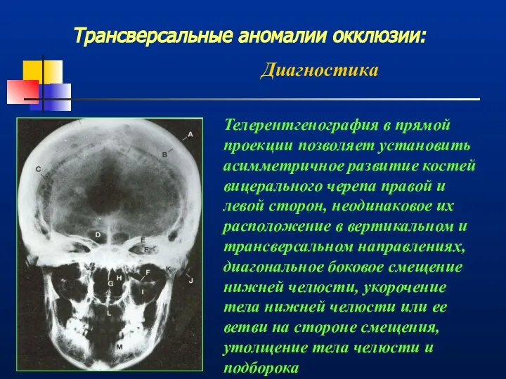 Трансверсальные аномалии окклюзии: Диагностика Телерентгенография в прямой проекции позволяет установить асимметричное