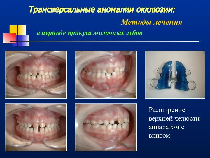 Трансверсальные аномалии окклюзии: Методы лечения Расширение верхней челюсти аппаратом с винтом в периоде прикуса молочных зубов