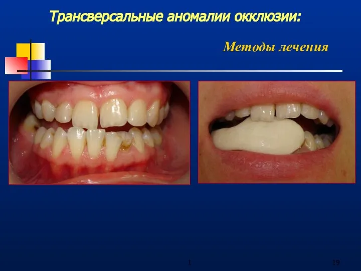1 Трансверсальные аномалии окклюзии: Методы лечения