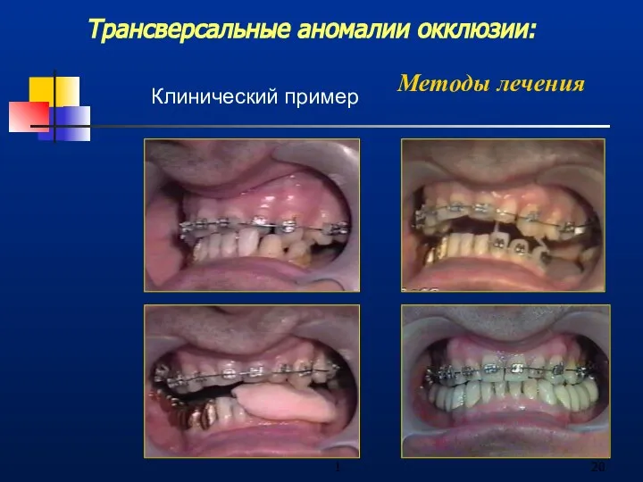 1 Трансверсальные аномалии окклюзии: Методы лечения Клинический пример