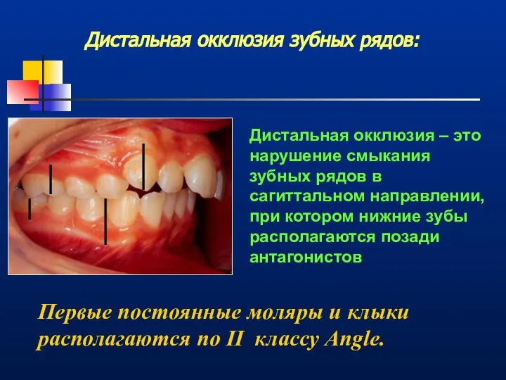 Дистальная окклюзия зубных рядов: Дистальная окклюзия – это нарушение смыкания зубных