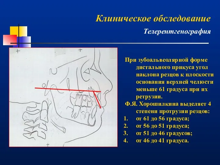 При зубоальвеолярной форме дистального прикуса угол наклона резцов к плоскости основания