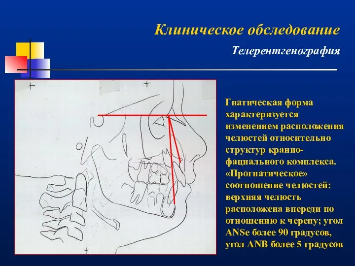 Гнатическая форма характеризуется изменением расположения челюстей относительно структур кранио-фациального комплекса. «Прогнатическое»