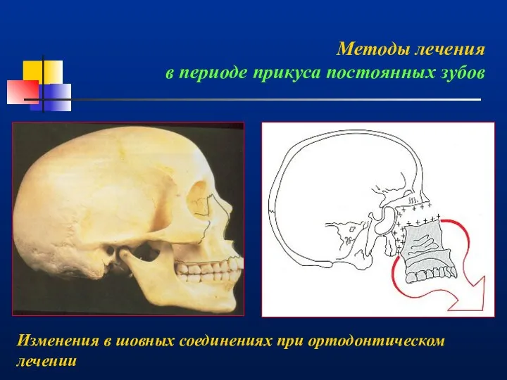 Изменения в шовных соединениях при ортодонтическом лечении Методы лечения в периоде прикуса постоянных зубов