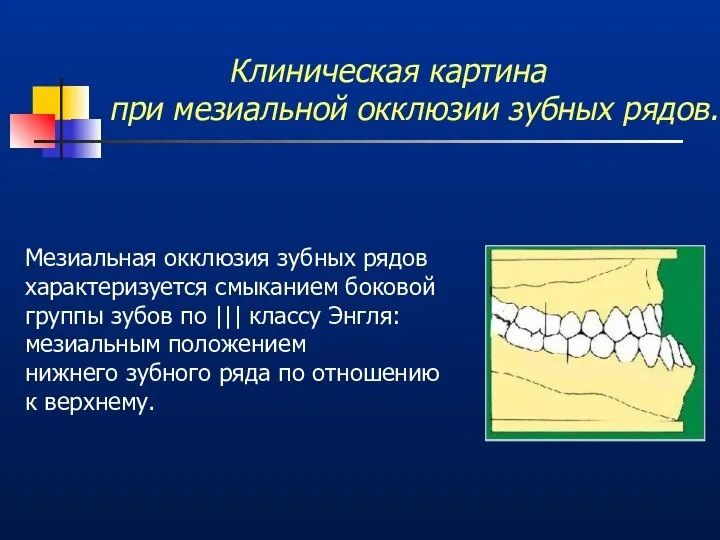 Клиническая картина при мезиальной окклюзии зубных рядов. Мезиальная окклюзия зубных рядов