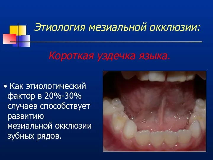 Этиология мезиальной окклюзии: Короткая уздечка языка. Как этиологический фактор в 20%-30%