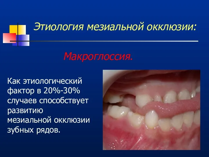 Этиология мезиальной окклюзии: Макроглоссия. Как этиологический фактор в 20%-30% случаев способствует развитию мезиальной окклюзии зубных рядов.