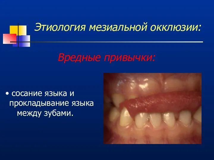 Этиология мезиальной окклюзии: Вредные привычки: сосание языка и прокладывание языка между зубами.