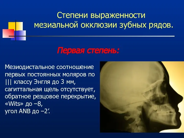 Степени выраженности мезиальной окклюзии зубных рядов. Первая степень: Мезиодистальное соотношение первых