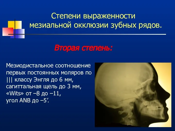 Степени выраженности мезиальной окклюзии зубных рядов. Мезиодистальное соотношение первых постоянных моляров