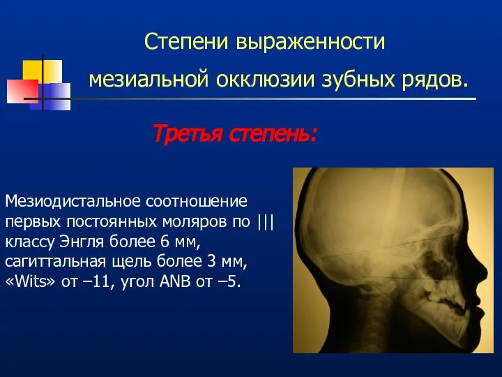 Степени выраженности мезиальной окклюзии зубных рядов. Третья степень: Мезиодистальное соотношение первых