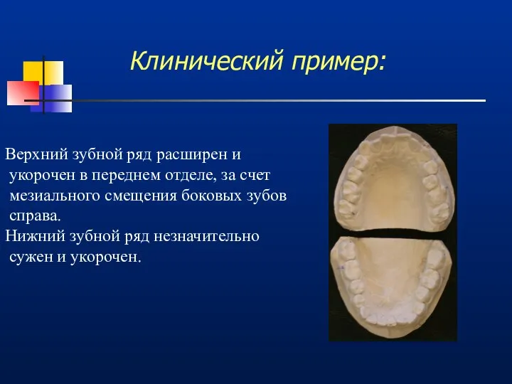 Клинический пример: Верхний зубной ряд расширен и укорочен в переднем отделе,