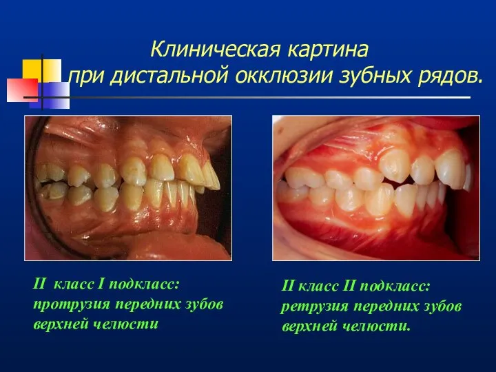 Клиническая картина при дистальной окклюзии зубных рядов. II класс I подкласс: