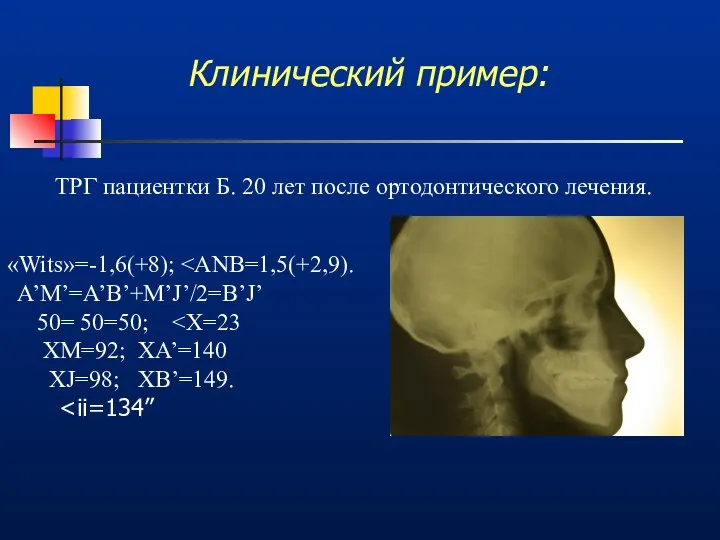 Клинический пример: ТРГ пациентки Б. 20 лет после ортодонтического лечения. «Wits»=-1,6(+8);