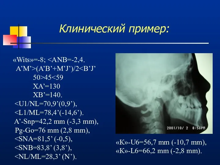 Клинический пример: «Wits»=-8; A’M’>(A’B’+M’J’)/2 50>45 XA’=130 XB’=140. A’-Snp=42,2 mm (-3,3 mm),