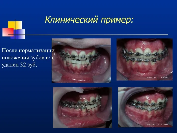 Клинический пример: После нормализации положения зубов в/ч удален 32 зуб.